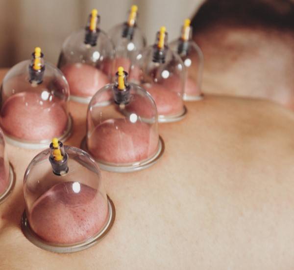 CUPPING THERAPY - 1ST WORKSHOP