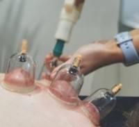 CUPPING THERAPY - 2ND WORKSHOP